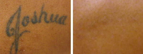 Before and after tattoo removal